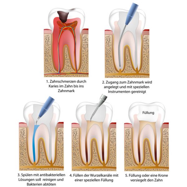 Endodontie | Wurzelkanalbehandlung